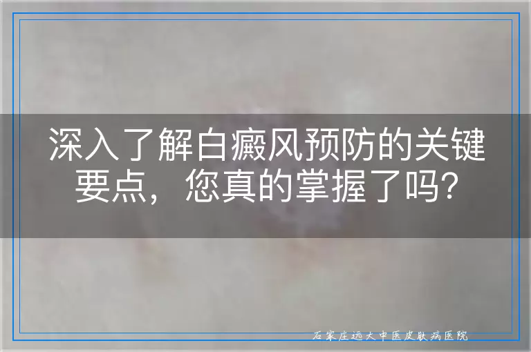深入了解白癜风预防的关键要点，您真的掌握了吗？