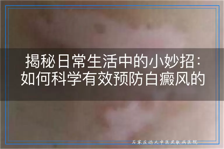 揭秘日常生活中的小妙招：如何科学有效预防白癜风的发生与扩散