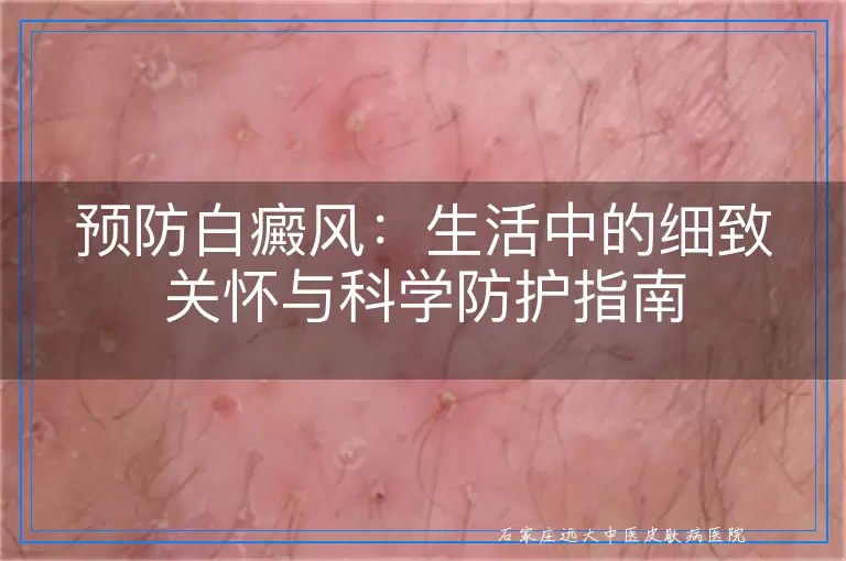 预防白癜风：生活中的细致关怀与科学防护指南