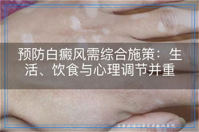 预防白癜风需综合施策:生活、饮食与心理调节并重