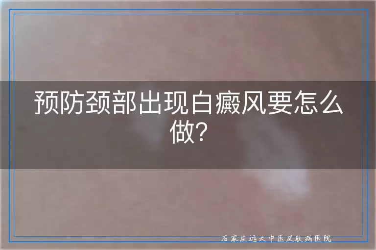 预防颈部出现白癜风要怎么做？