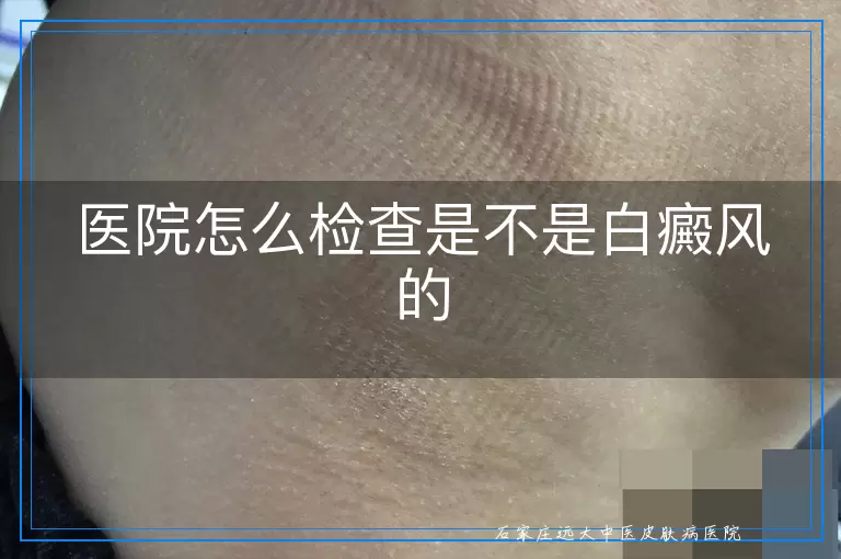 医院怎么检查是不是白癜风的