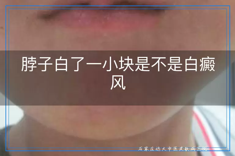 脖子白了一小块是不是白癜风