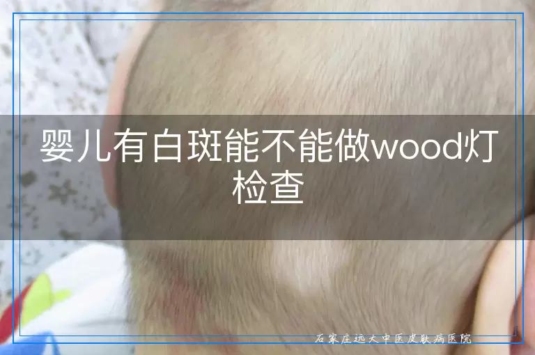 婴儿有白斑能不能做wood灯检查