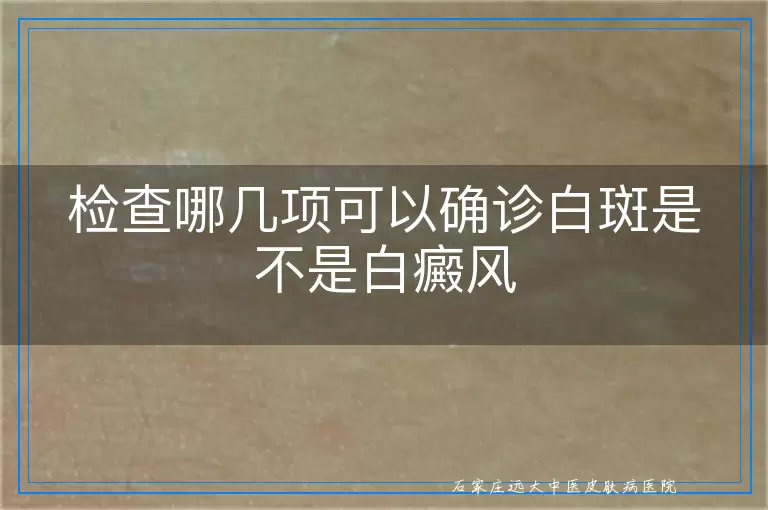 检查哪几项可以确诊白斑是不是白癜风