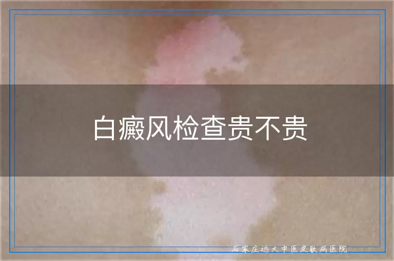 白癜风检查贵不贵
