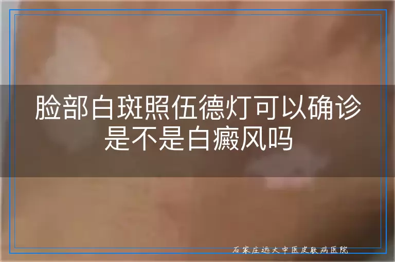 脸部白斑照伍德灯可以确诊是不是白癜风吗