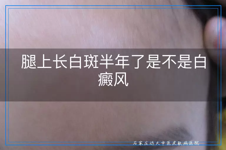 腿上长白斑半年了是不是白癜风