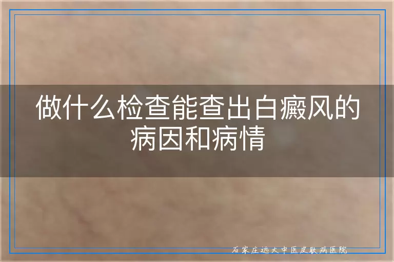 做什么检查能查出白癜风的病因和病情