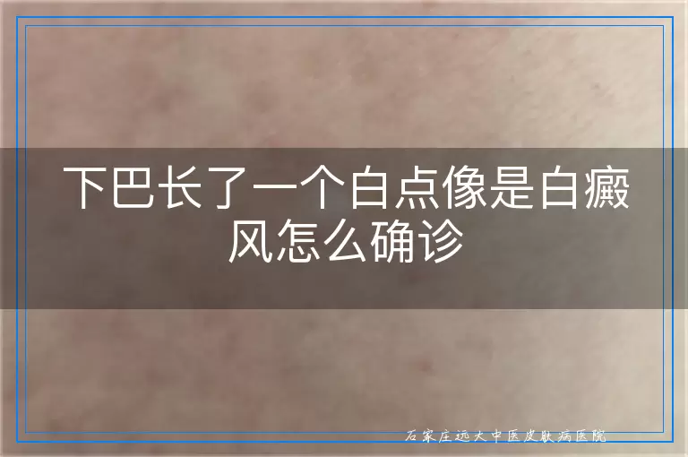 下巴长了一个白点像是白癜风怎么确诊