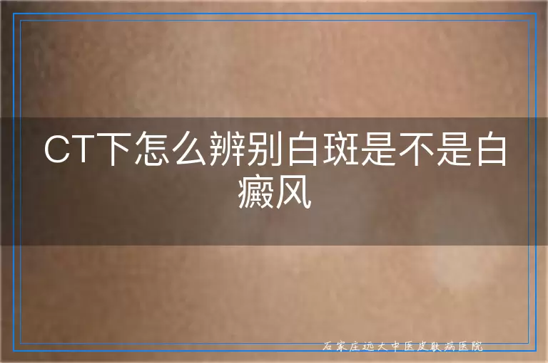 CT下怎么辨别白斑是不是白癜风