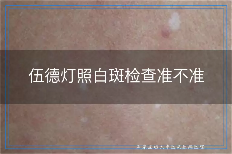 伍德灯照白斑检查准不准