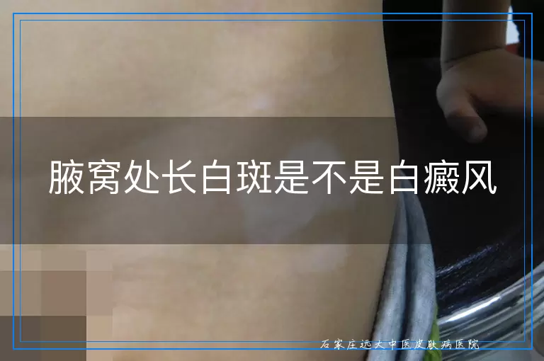 腋窝处长白斑是不是白癜风