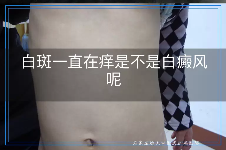 白斑一直在痒是不是白癜风呢