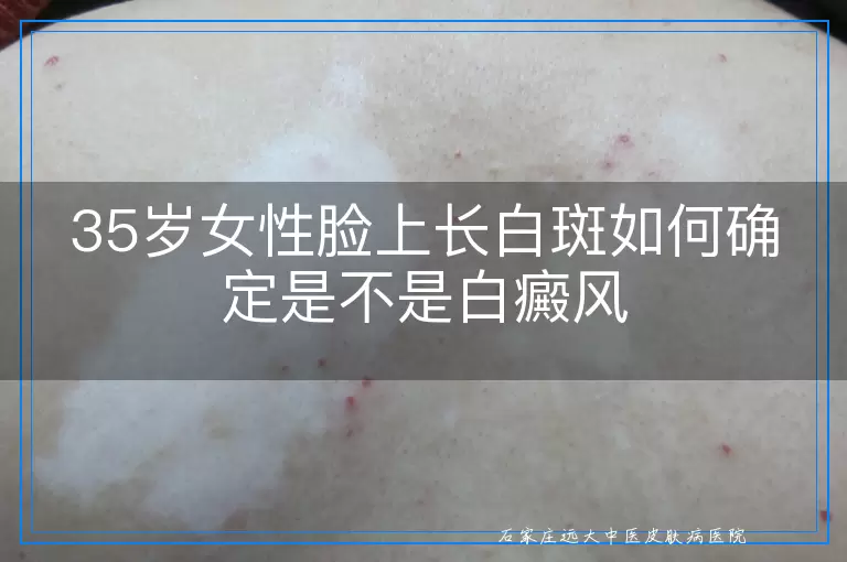 35岁女性脸上长白斑如何确定是不是白癜风