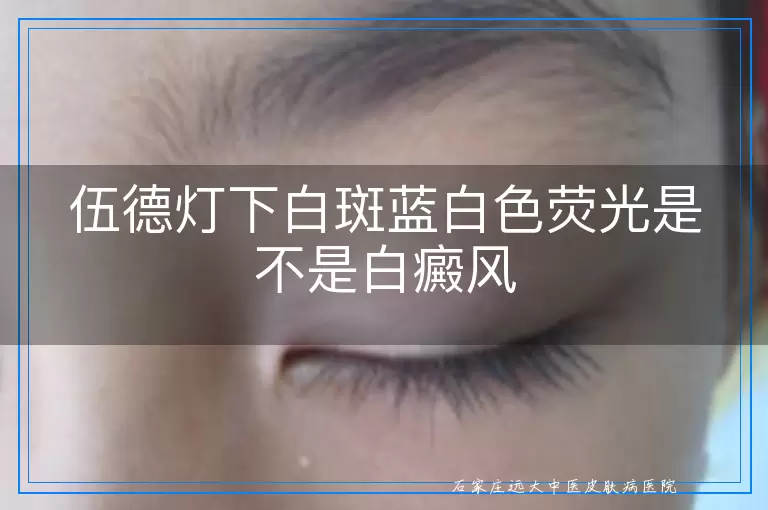 伍德灯下白斑蓝白色荧光是不是白癜风