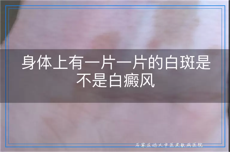 身体上有一片一片的白斑是不是白癜风