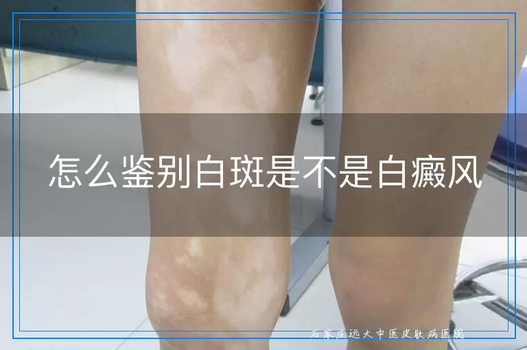 怎么鉴别白斑是不是白癜风