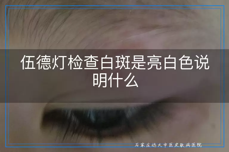 伍德灯检查白斑是亮白色说明什么
