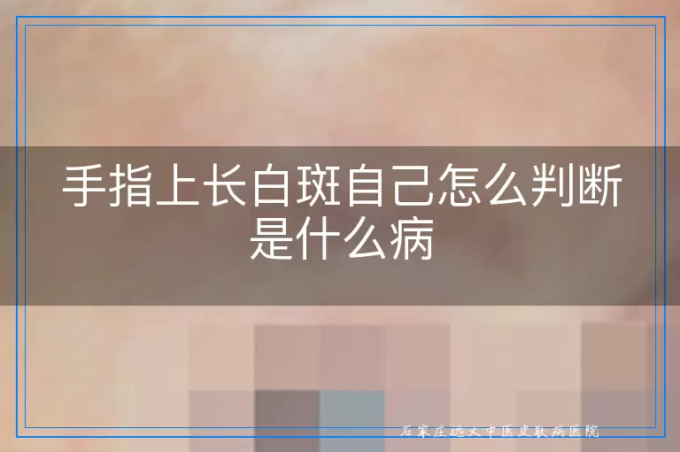 手指上长白斑自己怎么判断是什么病