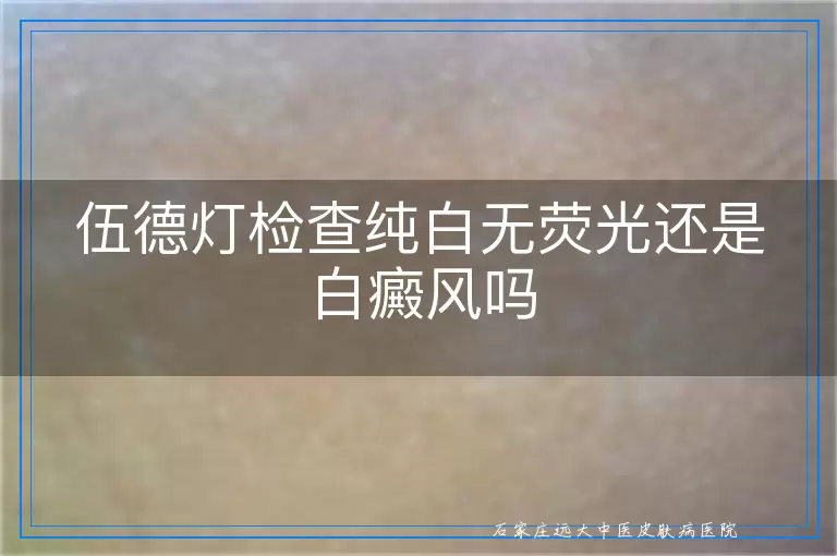 伍德灯检查纯白无荧光还是白癜风吗