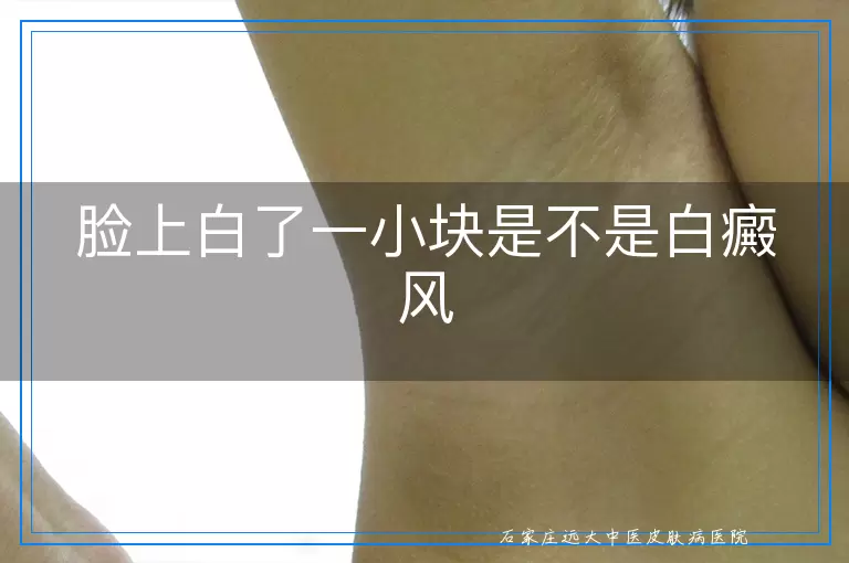脸上白了一小块是不是白癜风