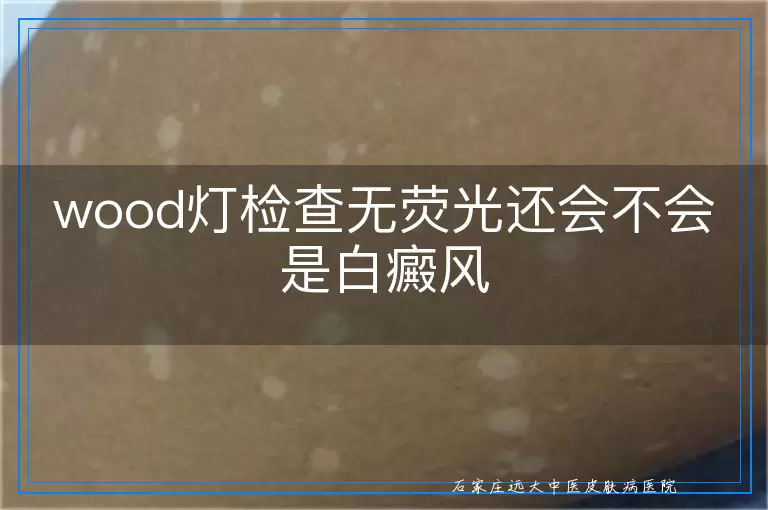 wood灯检查无荧光还会不会是白癜风