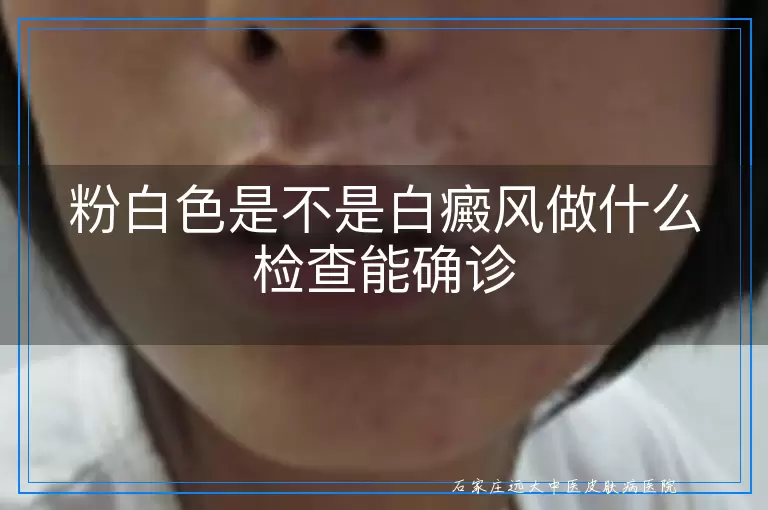 粉白色是不是白癜风做什么检查能确诊