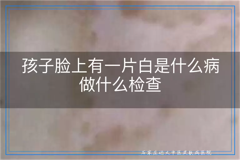 孩子脸上有一片白是什么病做什么检查