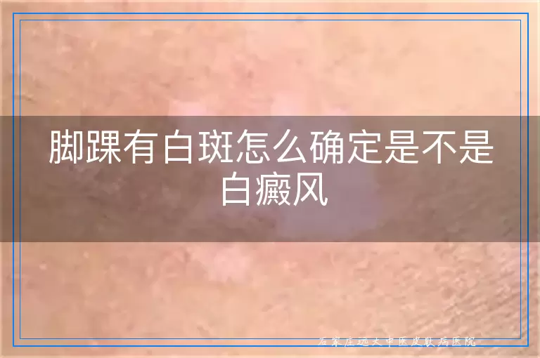 脚踝有白斑怎么确定是不是白癜风