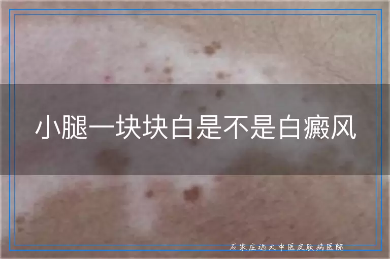 小腿一块块白是不是白癜风