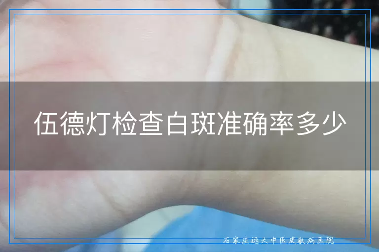 伍德灯检查白斑准确率多少