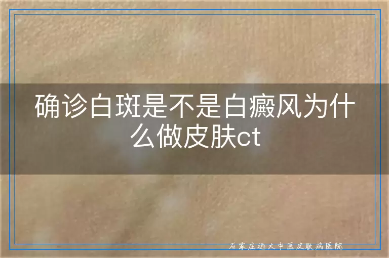 确诊白斑是不是白癜风为什么做皮肤ct