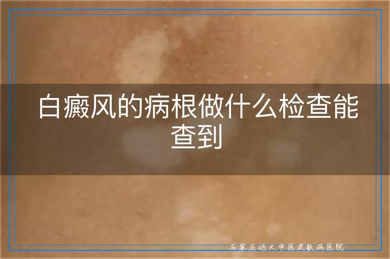 白癜风的病根做什么检查能查到