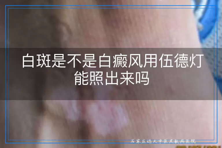 白斑是不是白癜风用伍德灯能照出来吗