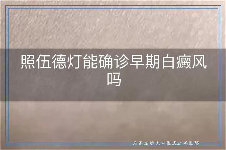照伍德灯能确诊早期白癜风吗