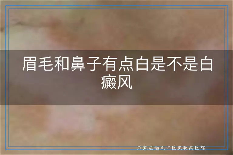 眉毛和鼻子有点白是不是白癜风