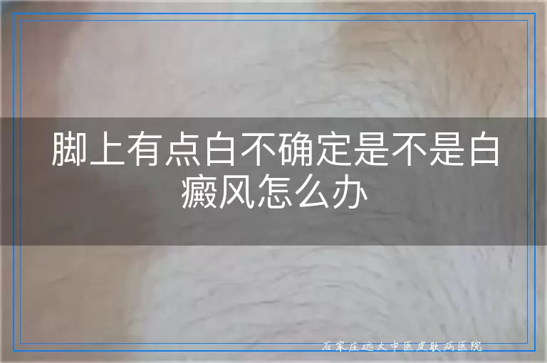 脚上有点白不确定是不是白癜风怎么办