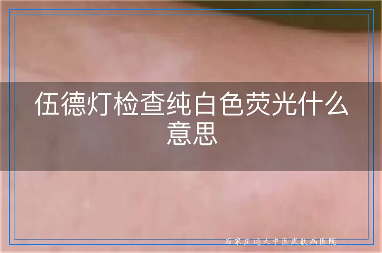 伍德灯检查纯白色荧光什么意思