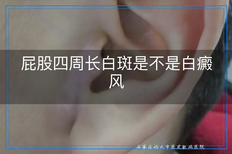 屁股四周长白斑是不是白癜风