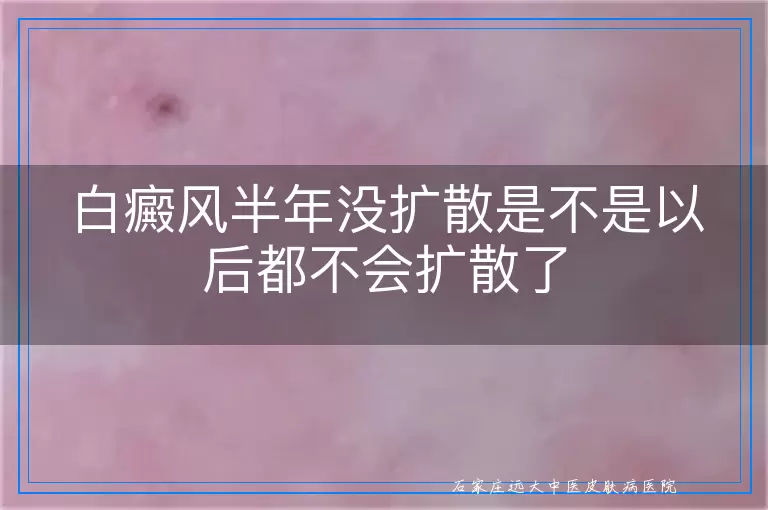 白癜风半年没扩散是不是以后都不会扩散了