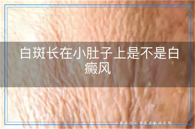 白斑长在小肚子上是不是白癜风