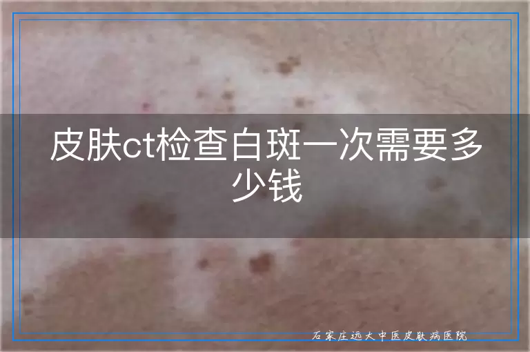 皮肤ct检查白斑一次需要多少钱