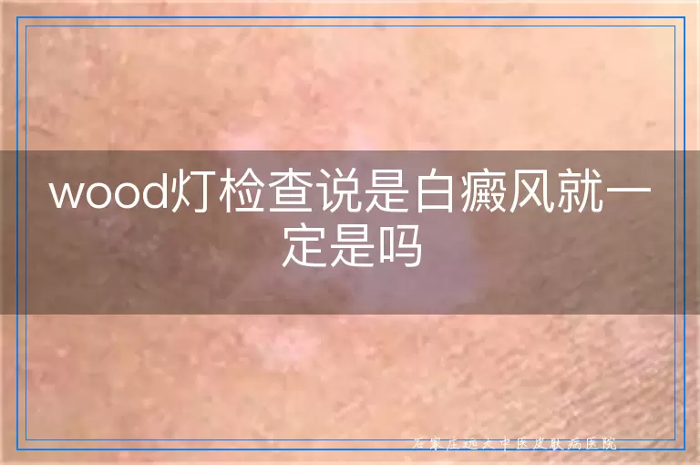 wood灯检查说是白癜风就一定是吗