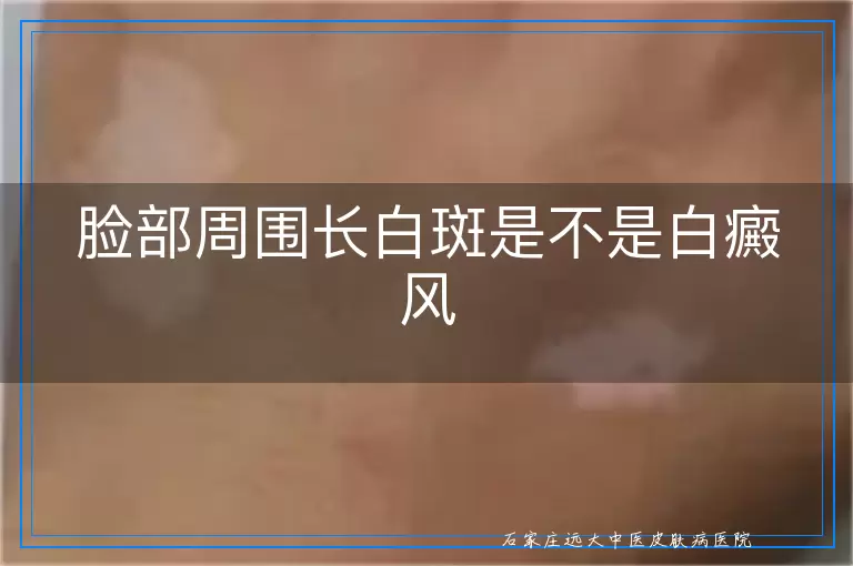 脸部周围长白斑是不是白癜风