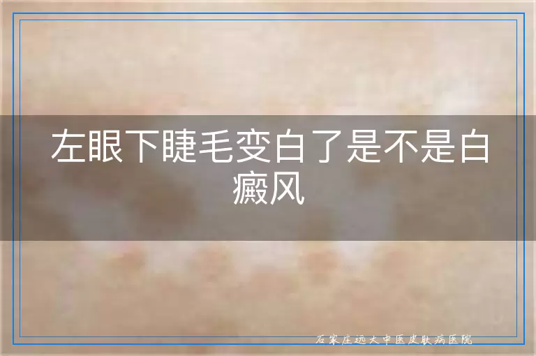 左眼下睫毛变白了是不是白癜风