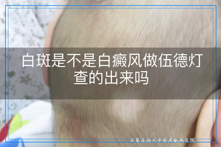 白斑是不是白癜风做伍德灯查的出来吗