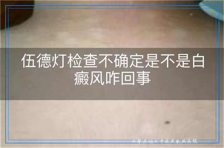 伍德灯检查不确定是不是白癜风咋回事