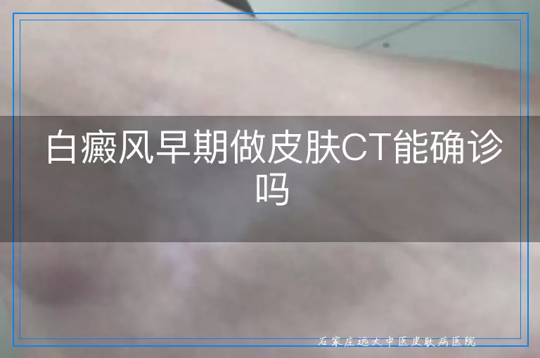 白癜风早期做皮肤CT能确诊吗