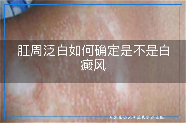肛周泛白如何确定是不是白癜风